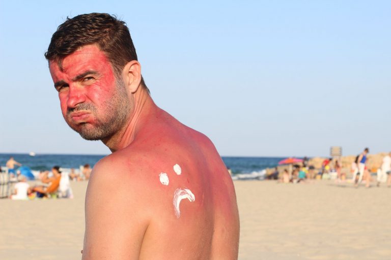 This Is What Happens To Your Skin When You Get Sunburned Vita Pura
